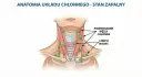 Anatomia układu chłonnego - stan zapalny. Widoczne powiększone węzły chłonne na szyi.