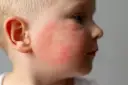 Czerwone policzki u dziecka, widoczny rumień.