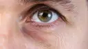 Eisenmangel symptome augen: Dunkle Augenringe und ihre Ursachen erkennen