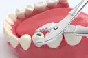 Chirurgiczne kleszcze dentystyczne chwytają ząb w jamie ustnej.