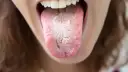 Liszaj w jamie ustnej: Jak rozpoznać objawy i co robić?