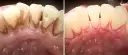 Przed i po leczeniu: zęby z osadem i oznakami ostrego zapalenia dziąseł po lewej, zdrowe dziąsła po prawej.