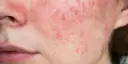 Gerötete Gesichtshaut: Ursachen, Symptome und effektive Behandlungsmöglichkeiten