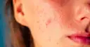 Skąd się biorą pryszcze? Oto przyczyny, które musisz znać