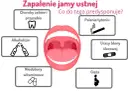 Skuteczne płukanki na stan zapalny jamy ustnej, które przynoszą ulgę