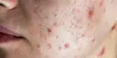 Zbliżenie na skórę twarzy z widocznymi pryszczami i zaczerwienieniami.