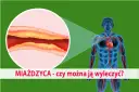 Jakie leki na miażdżycę mogą uratować Twoje serce i zdrowie?