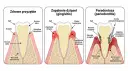 Ilustracja pokazuje postęp chorób przyzębia: zdrowe dziąsła, zapalenie dziąseł i paradontozę. Czy paradontoza jest zaraźliwa?
