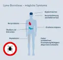 Borreliose Symptome: So erkennen Sie die Anzeichen einer Zeckeninfektion