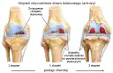 Skuteczne metody na ból kolana przy zmianach zwyrodnieniowych