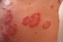 Czerwone, łuszczące się plamy na skórze, przypominające objawy atopowego zapalenia skóry.