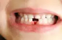 Wypadanie zębów mlecznych: objawy, kalendarz i kiedy do dentysty?