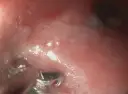 Endoskopowa ocena jelita grubego u psa z podejrzeniem IBD. Widoczne zmiany zapalne błony śluzowej.