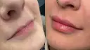 Powiększanie ust: Kwas hialuronowy, lip lift czy domowe triki?