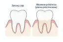 Zdrowy ząb obok zęba z wczesną próchnicą, czyli plamą próchnicową. Dentysta widzi różnicę w kolorze i strukturze szkliwa.