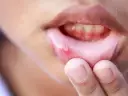 Rany w ustach? Szybkie gojenie i ulga: Domowe i apteczne triki