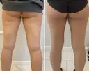 Redukcja cellulitu na udach: Twój plan na gładką skórę