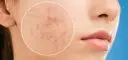 Co powoduje pryszcze? Poznaj przyczyny i sposoby na ich uniknięcie