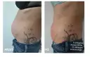 Przed i po zabiegu Accent Prime. Widoczna redukcja tkanki tłuszczowej brzucha, co pokazuje skuteczność liposukcji kawitacyjnej.
