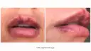 Martwica ust po kwasie hialuronowym: rozpoznaj objawy i działaj!