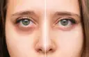 Botoks pod oczy: Kiedy efekty? Pełny rezultat po 10-14 dniach