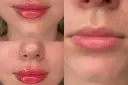 Gojenie ust po kwasie hialuronowym: Sprawdź, co Cię czeka krok po kroku