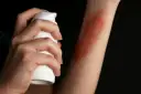 Dłoń aplikuje spray na rękę z widocznymi bliznami po oparzeniu 2 stopnia.