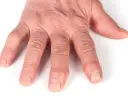 Guzki Heberdena: Do jakiego lekarza? Reumatolog czy ortopeda?