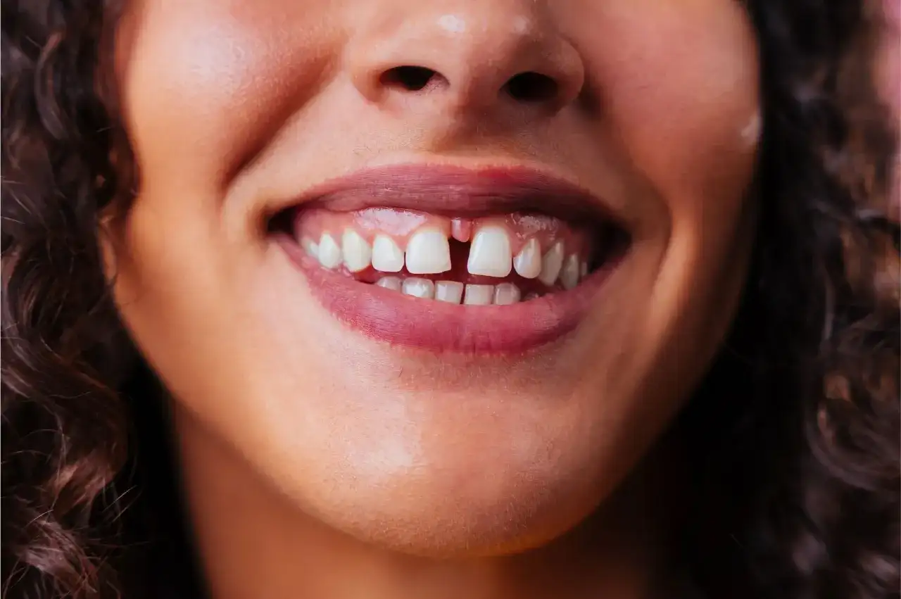Diastema - Przerwa między jedynkami - Kiedy leczyć, kiedy nie?