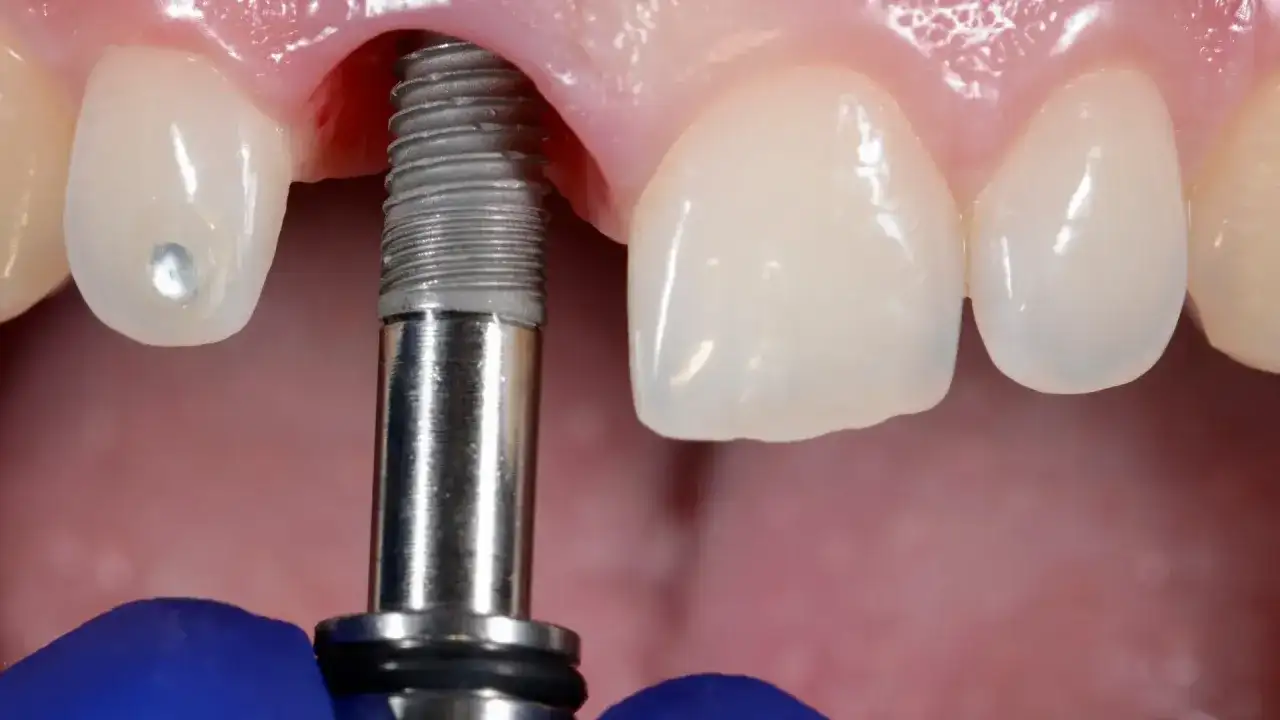Implant zęba - Przewodnik: zabieg, koszty, gojenie i pielęgnacja