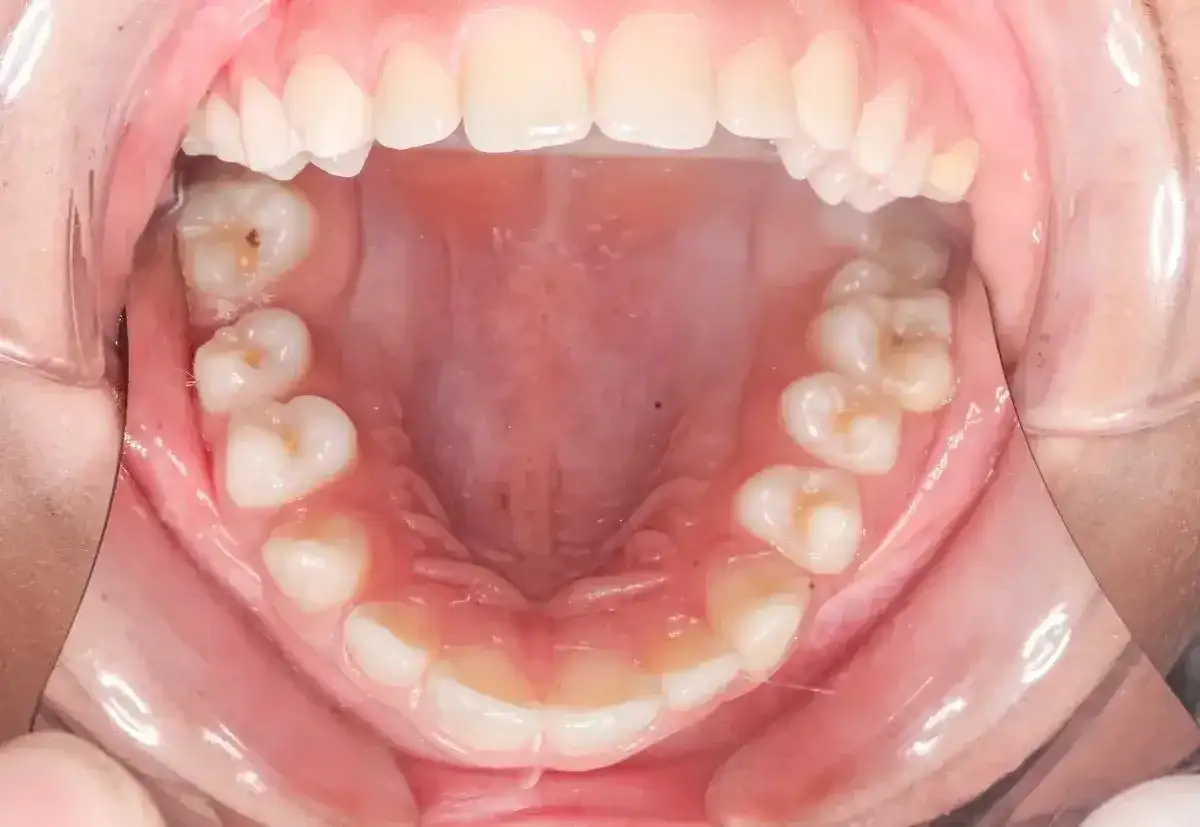Poparzone dziąsła - co zrobić od razu i kiedy iść do dentysty?