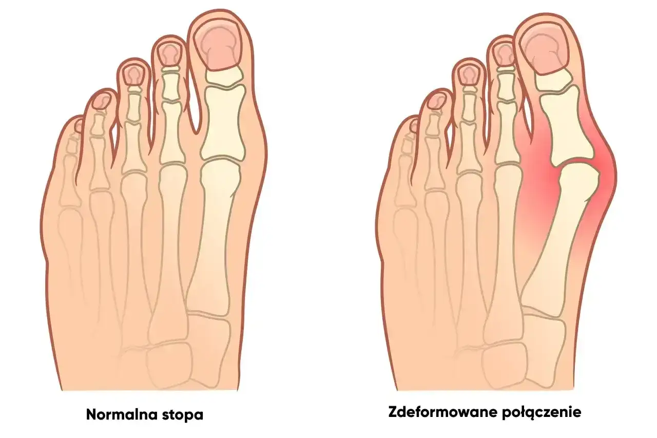 Początki haluksów - jakie objawy warto zauważyć?