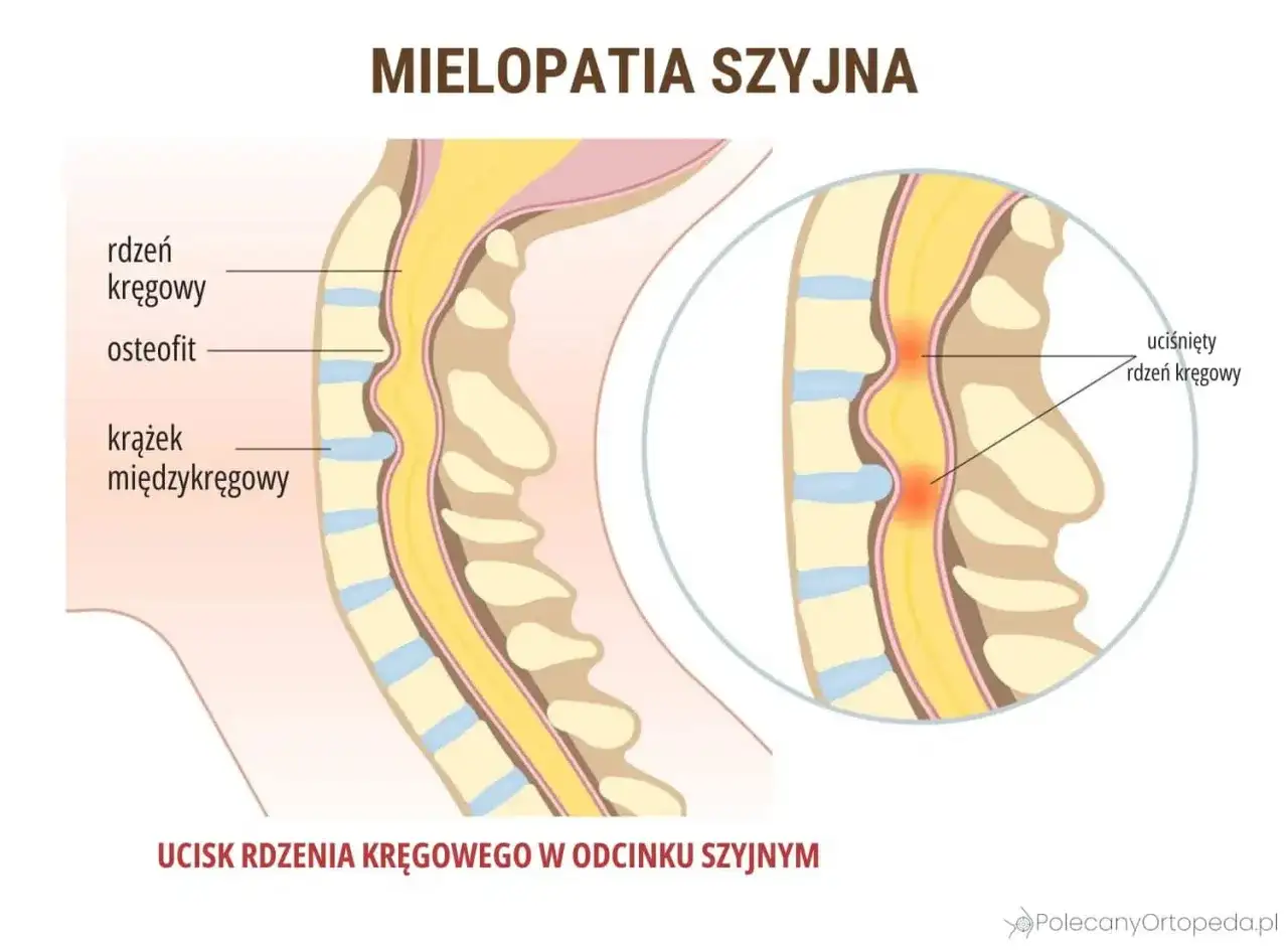 Drętwienie barku - nerw, szyja czy staw? Rozwiąż zagadkę!