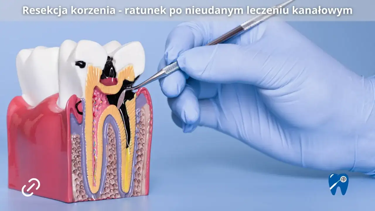 Resekcja wierzchołka korzenia – Jak uratować ząb po leczeniu kanałowym?