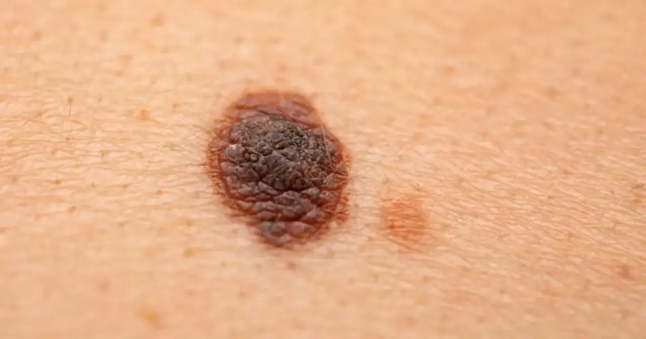 Swędzące znamię - Czy to czerniak? Kiedy iść do dermatologa?