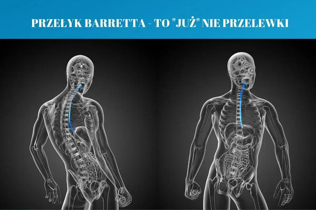Przełyk Barretta - czy na pewno wiesz, co oznacza?