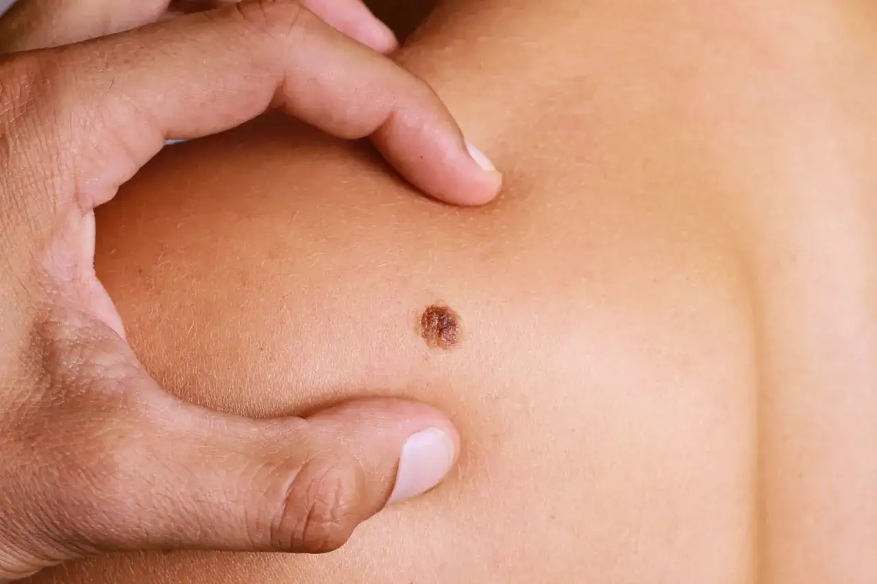 Suchy pieprzyk - przesuszenie czy sygnał do dermatologa?