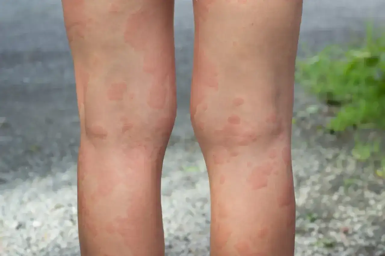 Wysypka na nogach - Czy to zawsze alergia? Rozpoznaj przyczyny