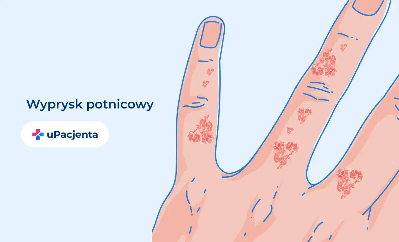 Egzema - Wyleczalna czy kontrolowalna? Sprawdź, co działa!