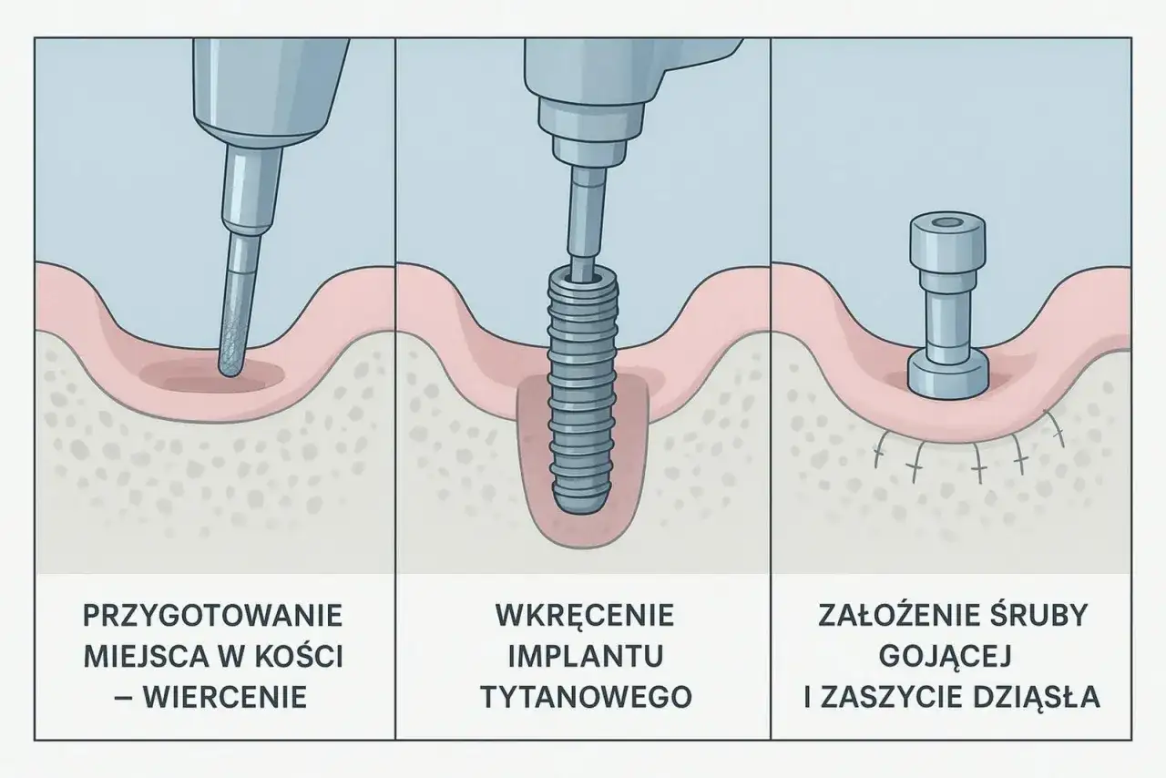 Implant zęba - czy boli? Poznaj fakty i przygotuj się