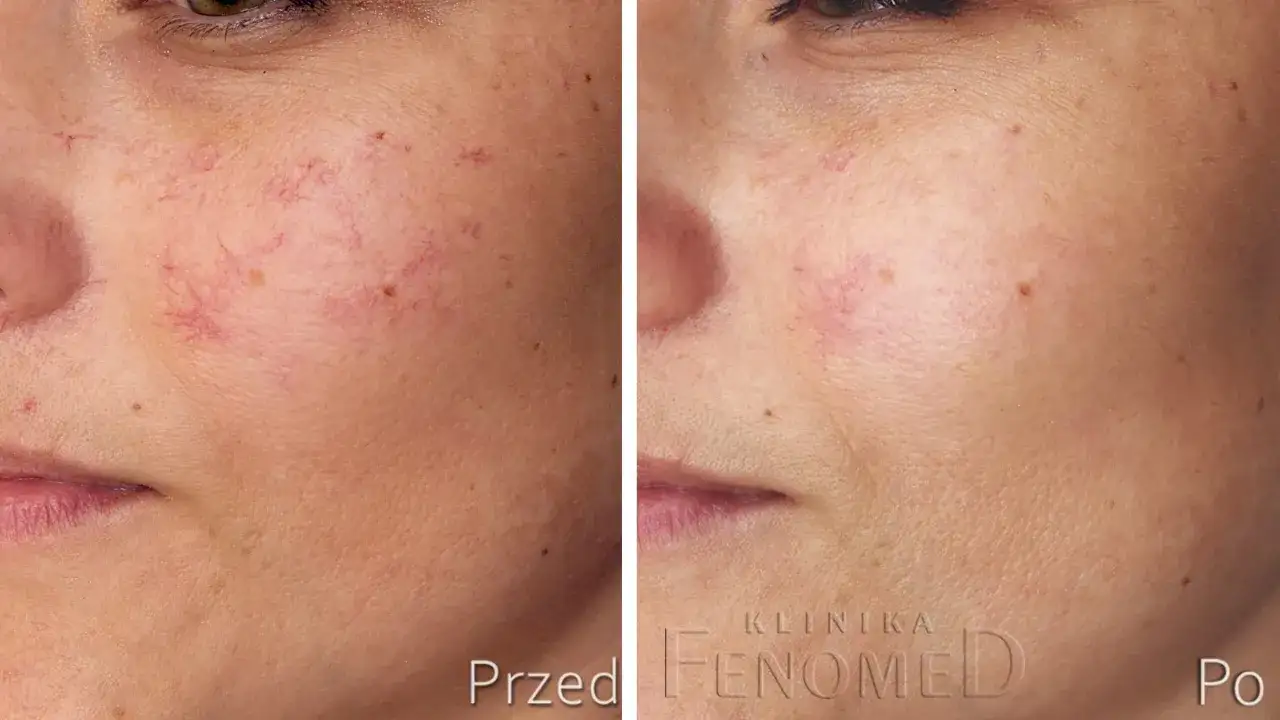 Zamykanie naczynek na twarzy - co daje laser, a co IPL?