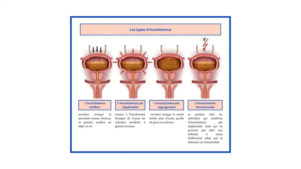 Fuite d’urine en éternuant ? Comprendre l’incontinence d’effort