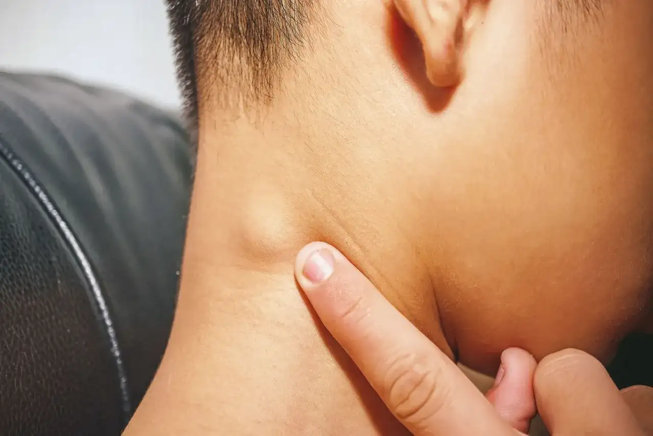 Ziarnica złośliwa - jak długo się żyje? Poznaj realne rokowania
