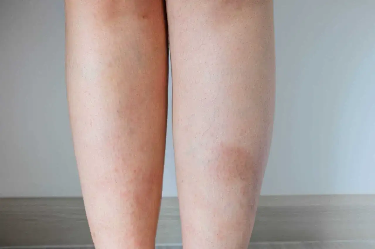 Paciorkowce na skórze - Liszajec, róża, cellulitis - Kiedy do lekarza?