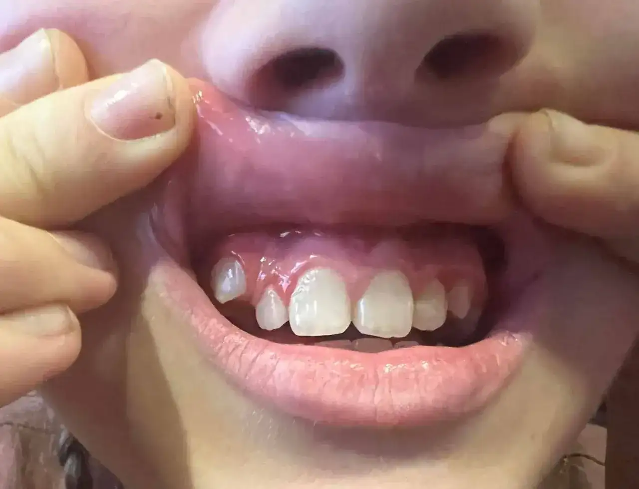 Ząb wyrasta bokiem z dziąsła? Co to znaczy i kiedy iść do dentysty