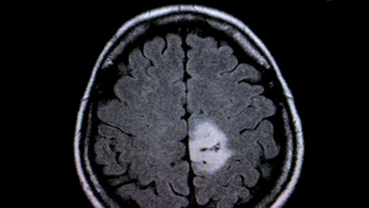 Hirntumor: Erste Anzeichen erkennen – Wann handeln?