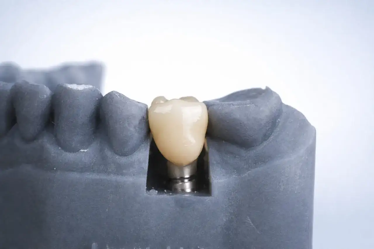 Implant zęba 6 - ile naprawdę kosztuje? Uniknij ukrytych opłat.