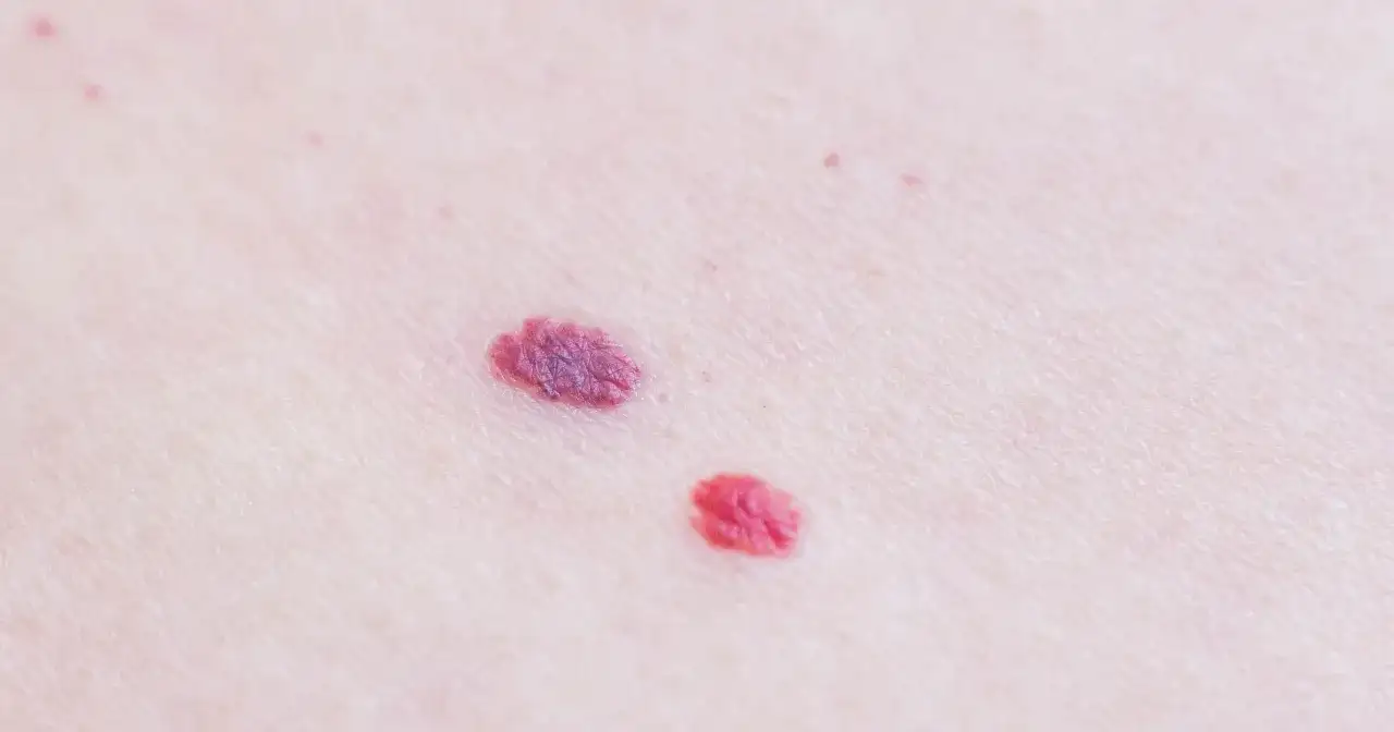 Czerwone pieprzyki - jak je rozpoznać i kiedy iść do dermatologa