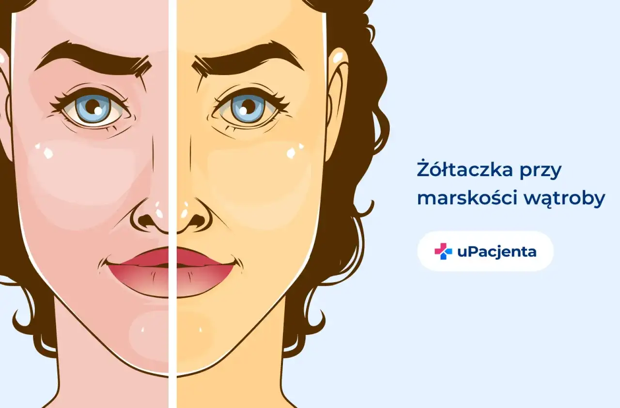 Marskość wątroby - Jak wygląda ostatni etap i kiedy reagować?