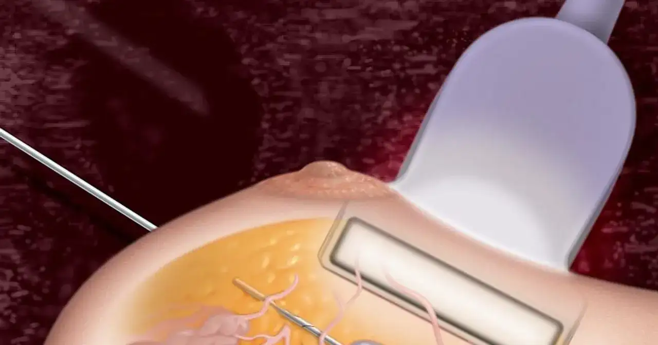 Biopsja piersi - Co musisz wiedzieć przed i po badaniu?